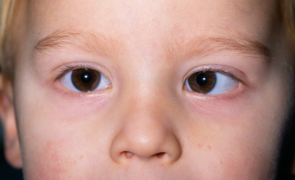 infantile esotropia