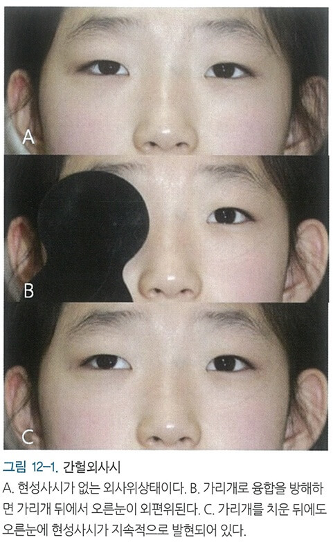 intermittent exotropia image