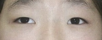 간헐외사시