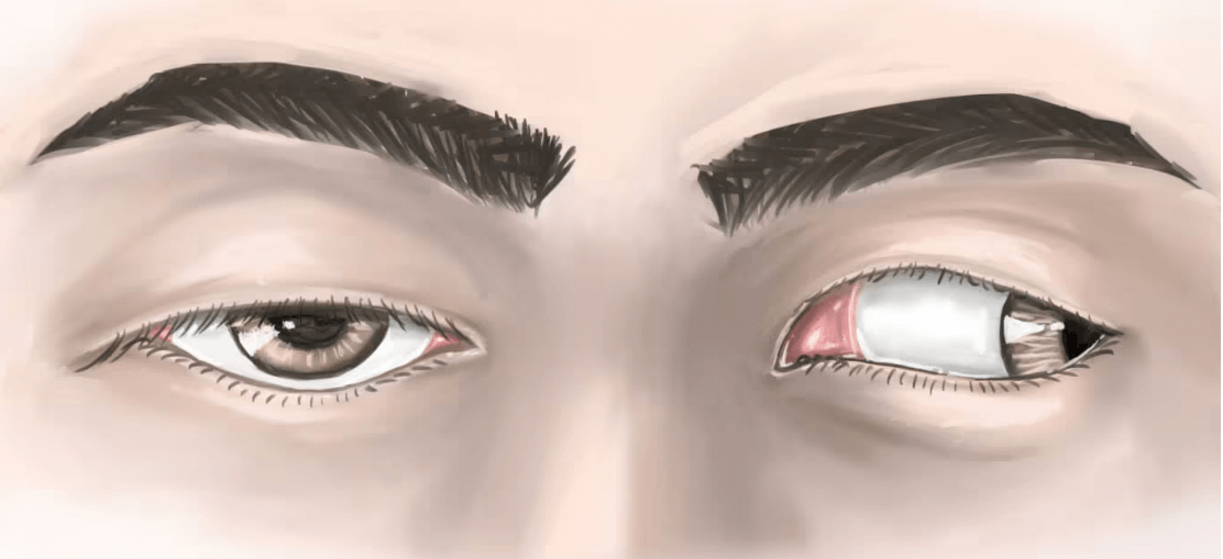 oculomotor-nerve-palsy-symptom