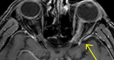 optic neuritis mri image