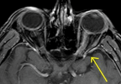optic neuritis mri image