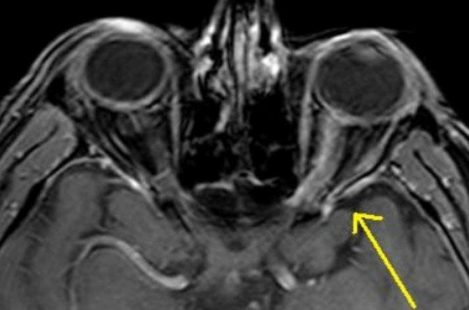 optic neuritis mri image